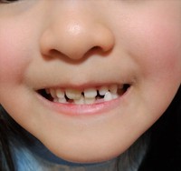 子供の歯科矯正開始から1年後のご報告です！！まだまだかかりそうです