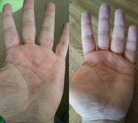 乾燥肌、アトピー性皮膚炎の改善